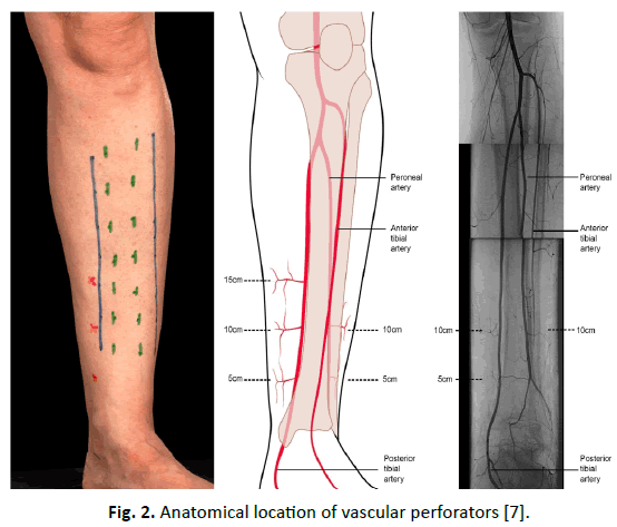 Tibia Lengthening and Deformity Correction With a Multiplanar External  Fixator