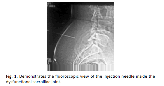 Orthopaedics-Trauma-Surgery-dysfunctional-sacroiliac-joint