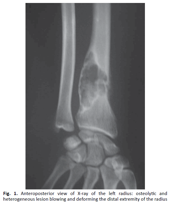 Pathologic Fracture Revealing Solid Aneurysmal Bone Cyst Of The Distal Radius 7422